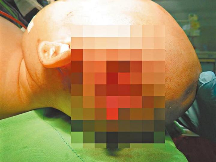 ■男嬰遭比特鬥牛㹴咬碎頭骨。台灣《蘋果日報》■咬傷男童的比特鬥牛㹴。 ■男嬰遭比特鬥牛㹴咬碎頭骨。台灣《蘋果日報》■咬傷男童的比特鬥牛㹴。