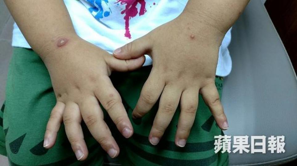 ■筆者指出,幼兒多「肺常不足,脾常不足」,當手足口病毒鬱於肺脾,致肺脾失健,水濕內停,可致患者出紅疹和發燒。資料圖片 ■筆者指出,幼兒多「肺常不足,脾常不足」,當手足口病毒鬱於肺脾,致肺脾失健,水濕內停,可致患者出紅疹和發燒。資料圖片