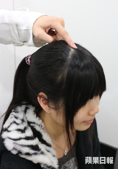 ■筆者指出,中醫治頭痛主要以中藥、針灸、推拿、按摩等方法為主。資料圖片 ■筆者指出,中醫治頭痛主要以中藥、針灸、推拿、按摩等方法為主。資料圖片