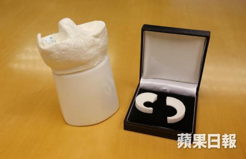■筆者介紹半月板再生術置入人工半月板支架,紓解膝關節痛及緩和退化速度。資料圖片 ■筆者介紹半月板再生術置入人工半月板支架,紓解膝關節痛及緩和退化速度。資料圖片