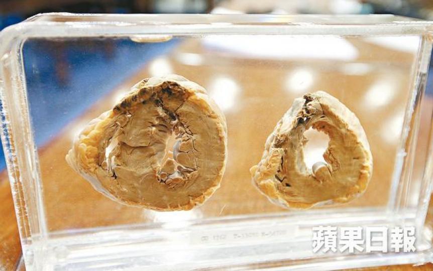 ■心肌梗塞的心臟切片標本顯示梗塞部份呈黑色。 ■心肌梗塞的心臟切片標本顯示梗塞部份呈黑色。