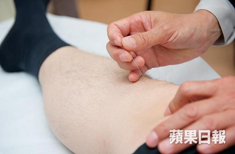 ■筋針是一種淺刺皮下,無感得氣,舒暢經筋的一種特殊針刺方法,有別於傳統針灸(圖)酸麻脹痛。 ■筋針是一種淺刺皮下,無感得氣,舒暢經筋的一種特殊針刺方法,有別於傳統針灸(圖)酸麻脹痛。