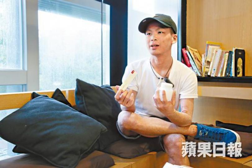 ■阿杰9個月前下定決心戒斷類固醇後，至今未有再使用類固醇藥物。夏家朗攝■皮膚仍粗糙和有破損的阿杰指狀況已比過去好。