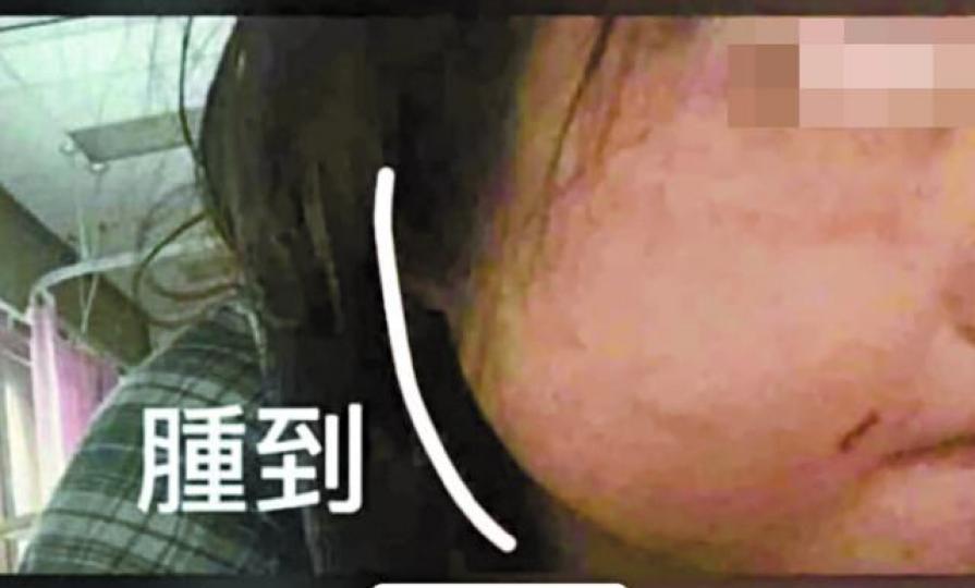 ■被虐打的14歲女童上載自拍照並寫上「腫到」展示傷勢。互聯網■受害女童事後在Instagram公開被童黨凌虐經過。 ■被虐打的14歲女童上載自拍照並寫上「腫到」展示傷勢。互聯網■受害女童事後在Instagram公開被童黨凌虐經過。