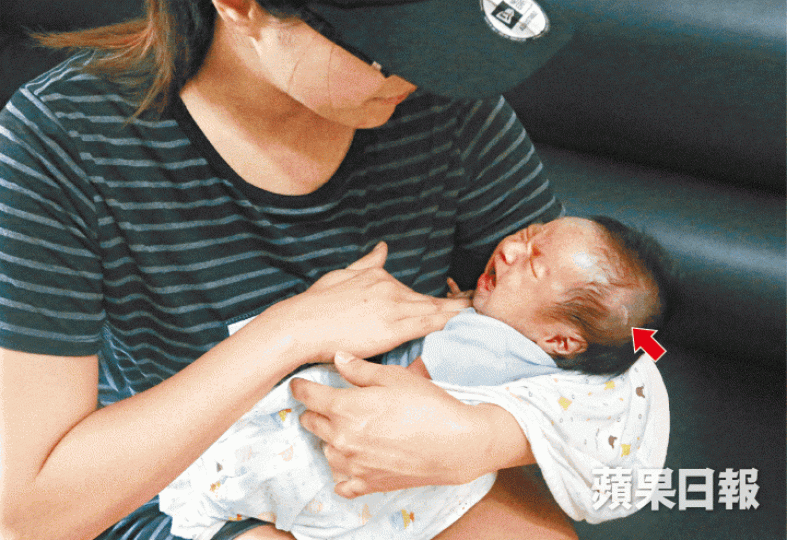 ■鄺小姐月初在屯門醫院剖腹產子,手術期間男嬰頭頂被割傷留疤(箭嘴示)。王子俊攝■屯門醫院指事發當日已立即為男嬰處理傷口及安排詳細檢查。■男嬰頭頂傷口長約兩厘米,事後需縫5針。鄺小姐提供圖片 ■鄺小姐月初在屯門醫院剖腹產子,手術期間男嬰頭頂被割傷留疤(箭嘴示)。王子俊攝■屯門醫院指事發當日已立即為男嬰處理傷口及安排詳細檢查。■男嬰頭頂傷口長約兩厘米,事後需縫5針。鄺小姐提供圖片
