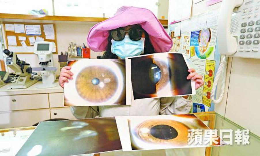 ■李太早前於美容師家中接受療程後傷及左眼，現時視力大致恢復。張志華攝周伯展醫生