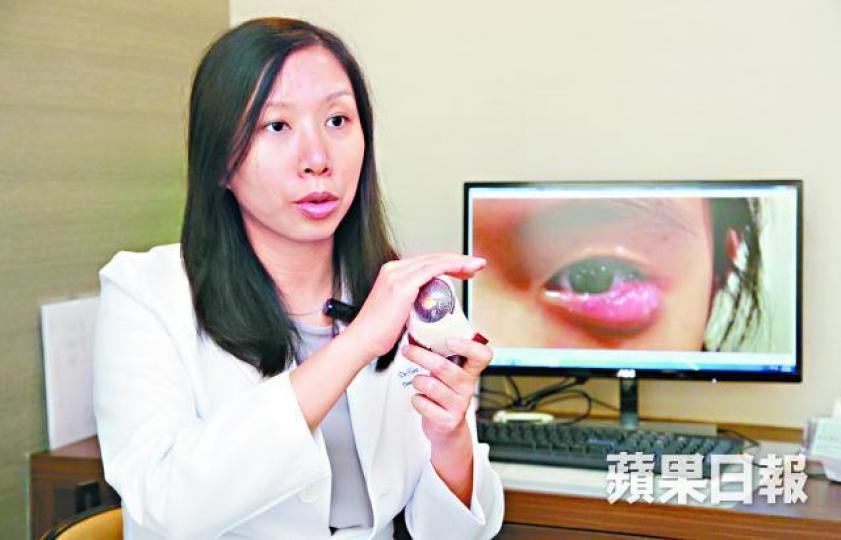 ■劉凱珊醫生稱幼童經常不洗手便捽眼,不少人玩波波池後生眼瘡。袁志中攝 ■劉凱珊醫生稱幼童經常不洗手便捽眼,不少人玩波波池後生眼瘡。袁志中攝