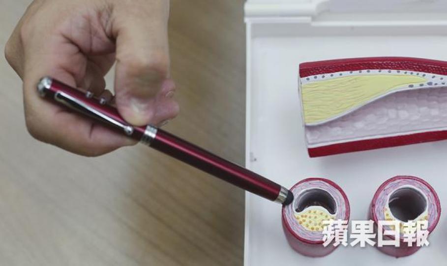 受情緒困擾人士,體內發炎因子和血小板過份活躍,易令向管有斑塊積聚,增心血管疾病風險。何頴賢攝
受情緒困擾人士,體內發炎因子和血小板過份活躍,易令向管有斑塊積聚,增心血管疾病風險。何頴賢攝