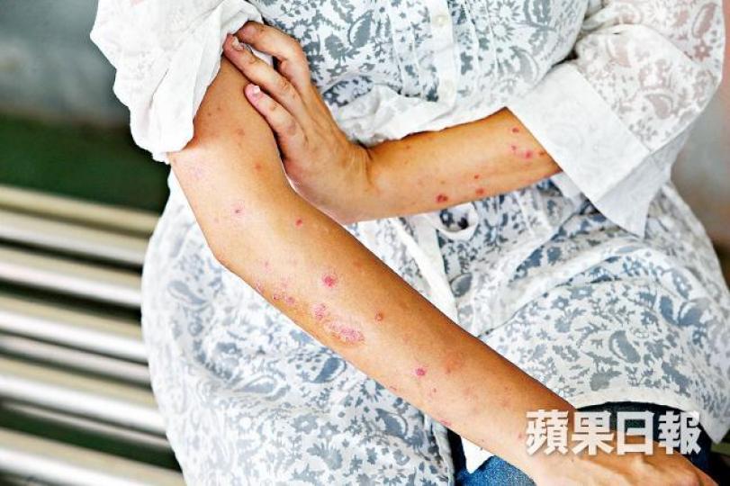 患銀屑病的Mimi多次向醫生查詢使用生物製劑的條件未果。王子俊攝Roger指病歷不互通令求診時出現不少困難。 患銀屑病的Mimi多次向醫生查詢使用生物製劑的條件未果。王子俊攝Roger指病歷不互通令求診時出現不少困難。