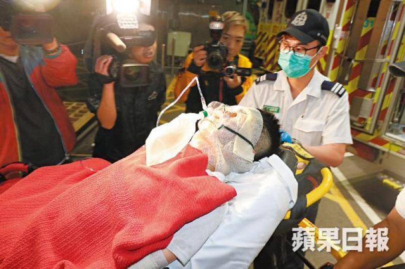 臉部燒傷的浸大學生用面膜初步敷治再送院。李家傑攝 臉部燒傷的浸大學生用面膜初步敷治再送院。李家傑攝