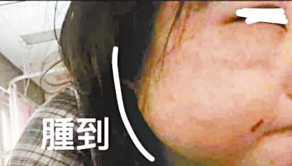今年7月,14歲事主曾上載照片展示臉部傷勢。 今年7月,14歲事主曾上載照片展示臉部傷勢。