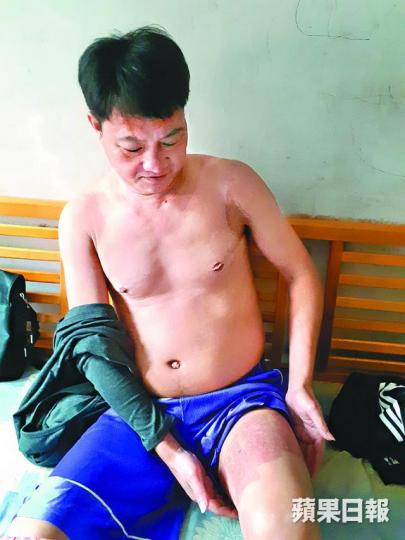 意外中尹晨光左手重創,須由左大腿取皮移植。徐雲庭攝 意外中尹晨光左手重創,須由左大腿取皮移植。徐雲庭攝