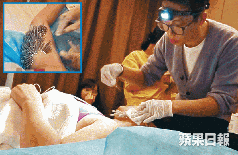 假醫生戴上登山頭燈充當手術照明,在少女臉及手臂插入多支針(小圖)埋線減肥。微整團中介Yoyo曾在網上貼出自己隆鼻失敗的相片。互聯網參與整形的少女(左)不會被告知酒店房間號碼,由假醫生(右)親自接上房。手術後床墊遺下血迹(箭嘴示)。 假醫生戴上登山頭燈充當手術照明,在少女臉及手臂插入多支針(小圖)埋線減肥。微整團中介Yoyo曾在網上貼出自己隆鼻失敗的相片。互聯網參與整形的少女(左)不會被告知酒店房間號碼,由假醫生(右)親自接上房。手術後床墊遺下血迹(箭嘴示)。